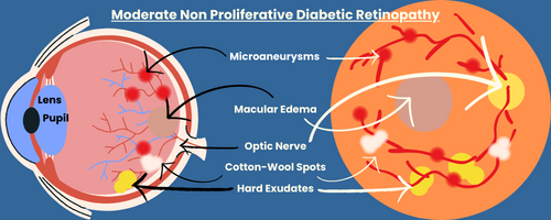 Titled, "Moderate non proliferative diabetic retinopathy"
Visually depicts components of moderate NPR on graphic of the retina and on the graphic of an eyeball.
