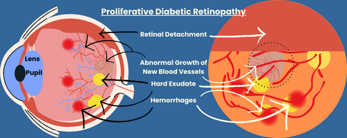 Titled, "Proliferative diabetic retinopathy"
Visually depicts components of PDR on graphic of the retina and on the graphic of an eyeball.