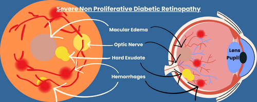 Titled, "severe non proliferative diabetic retinopathy"
Visually depicts components of severe NPR on graphic of the retina and on the graphic of an eyeball.